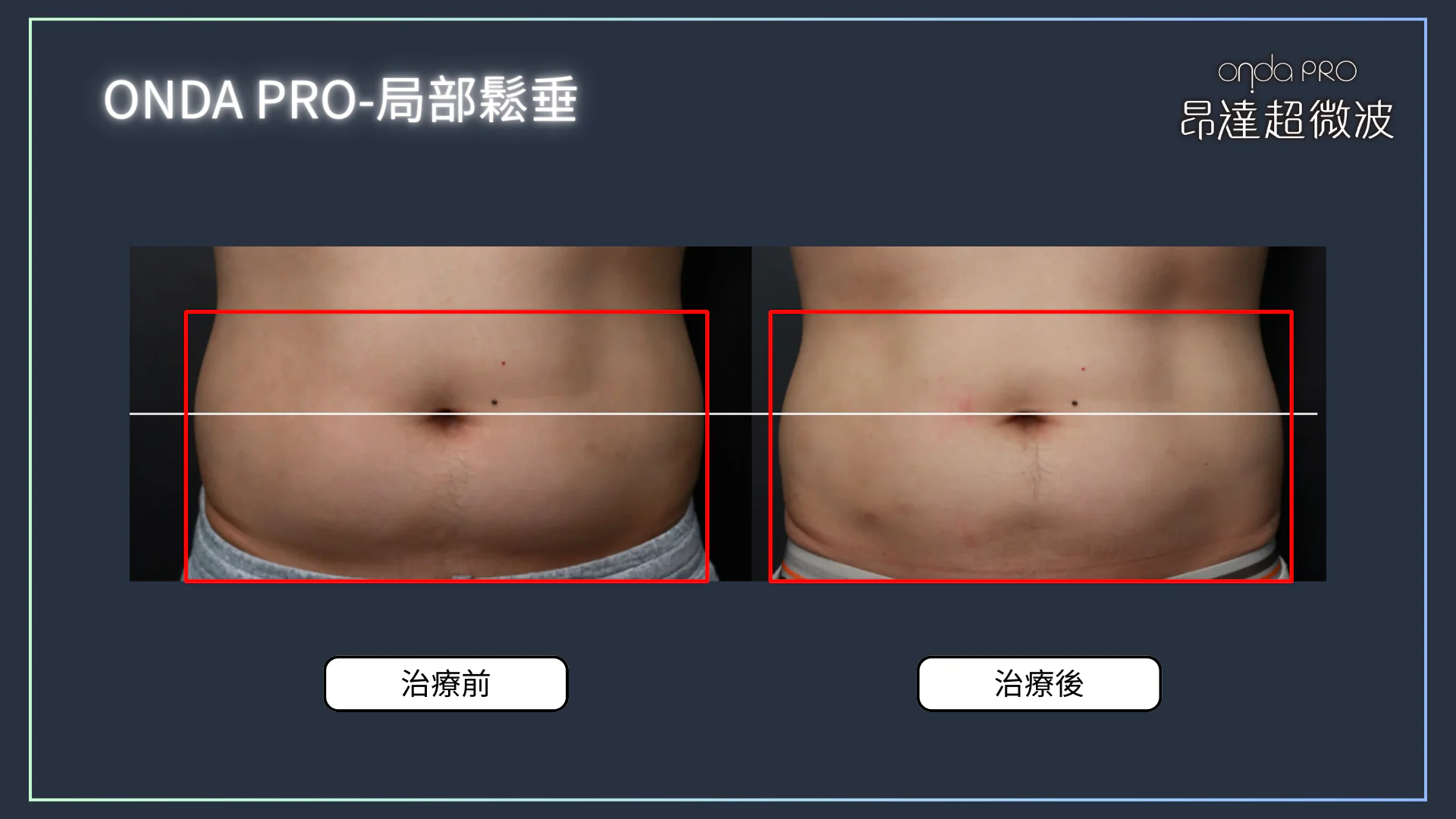 ONDA PRO 適合對象與療程應用部位