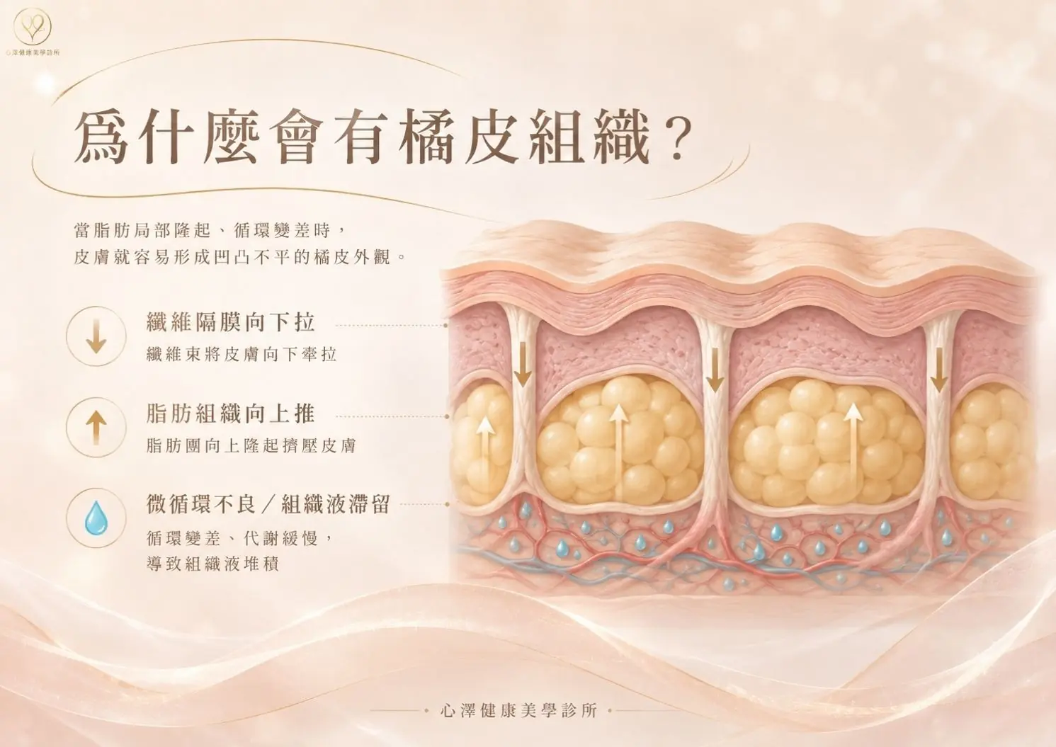 為什麼會有橘皮組織?