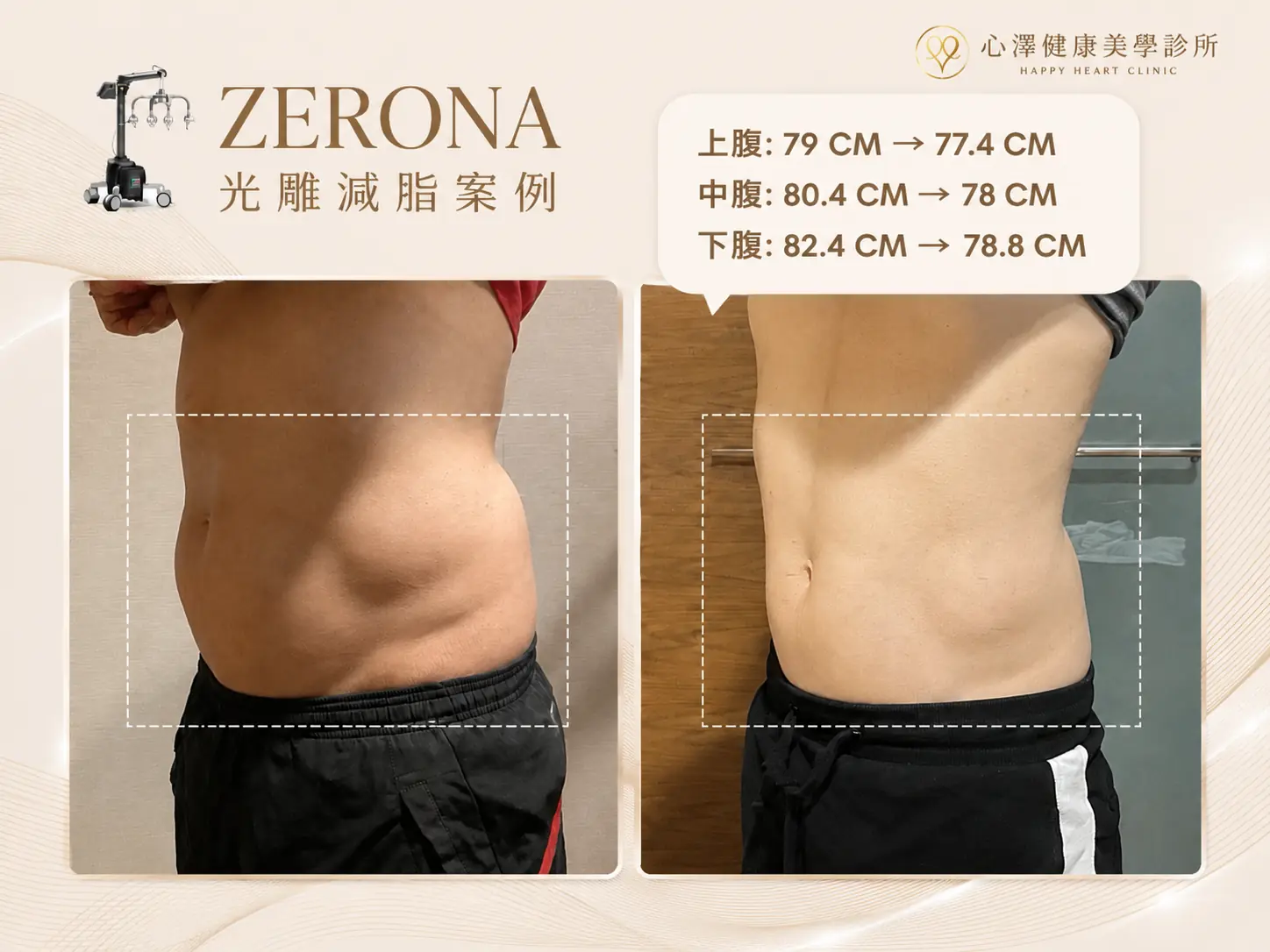 Zerona減脂案例