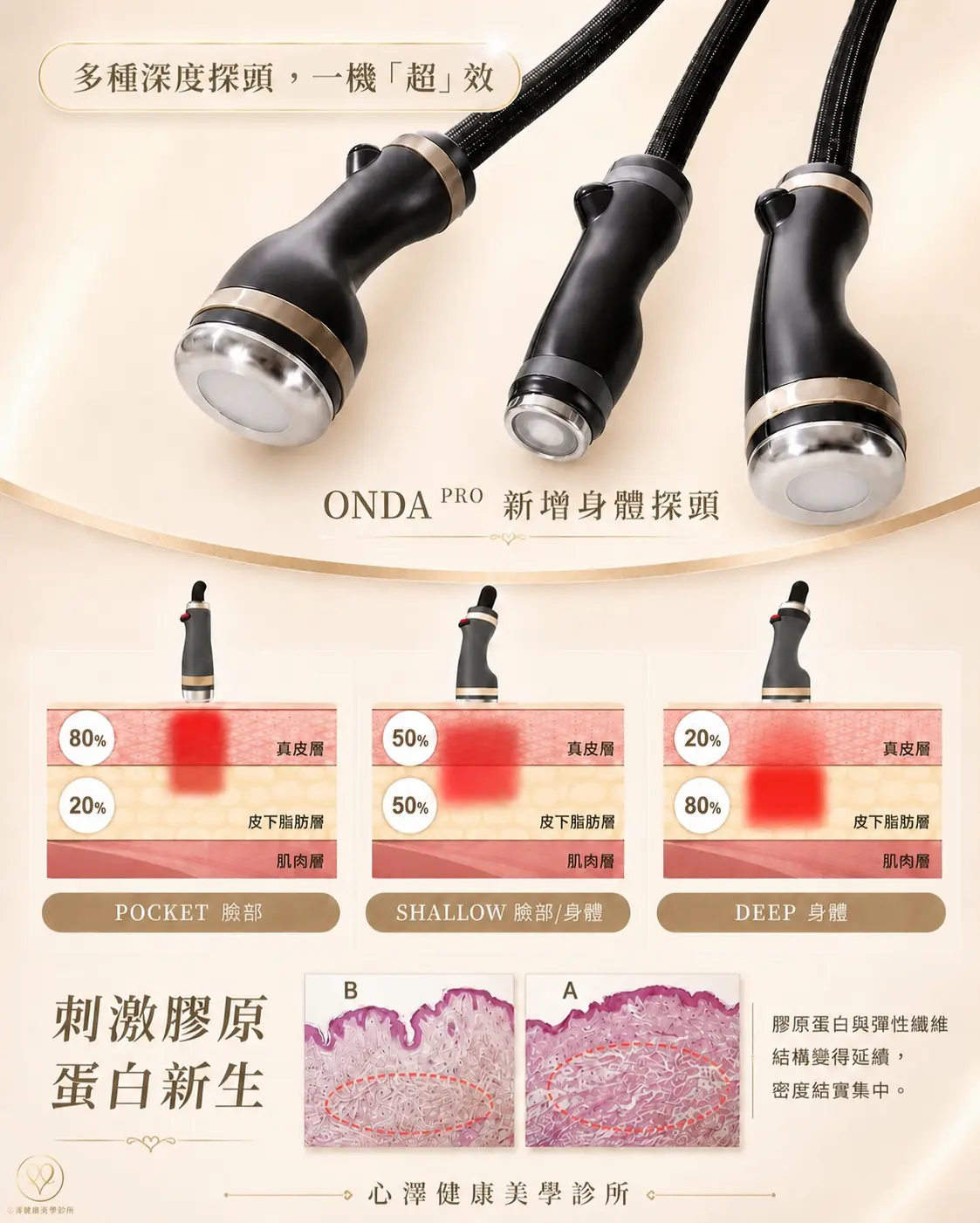 Onda Pro 超微波：輕鬆改善嘴邊肉與下顎線死角