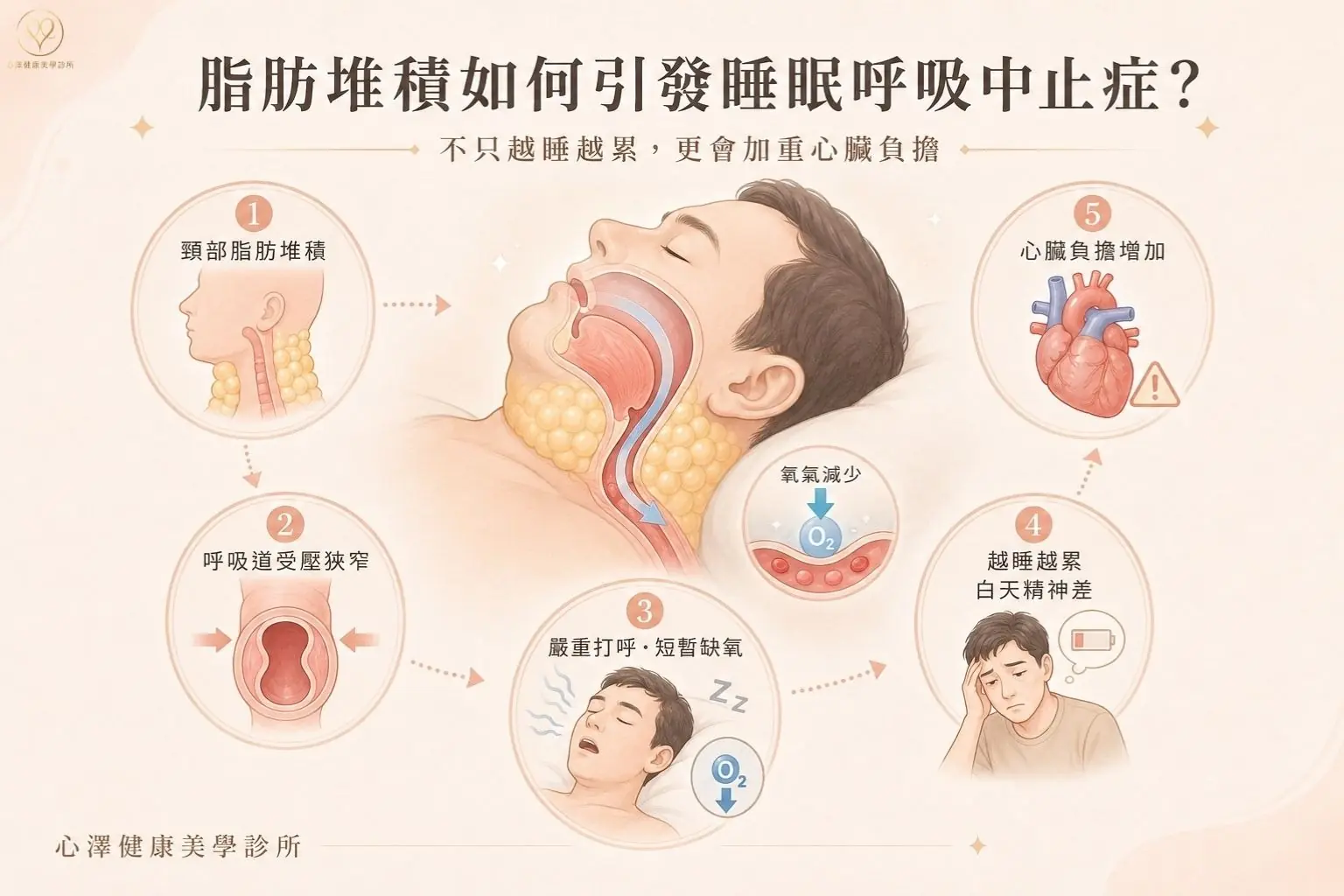 頸部周圍的脂肪過度堆積會擠壓、狹窄呼吸道,導致睡覺時嚴重打呼,甚至出現短暫呼吸暫停的缺氧狀況