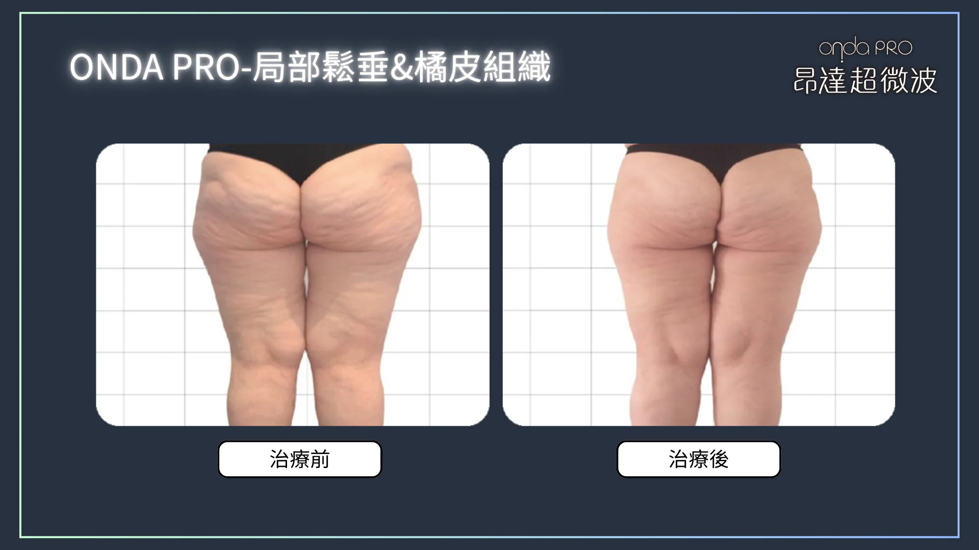 ONDA PRO 適合對象與療程應用部位