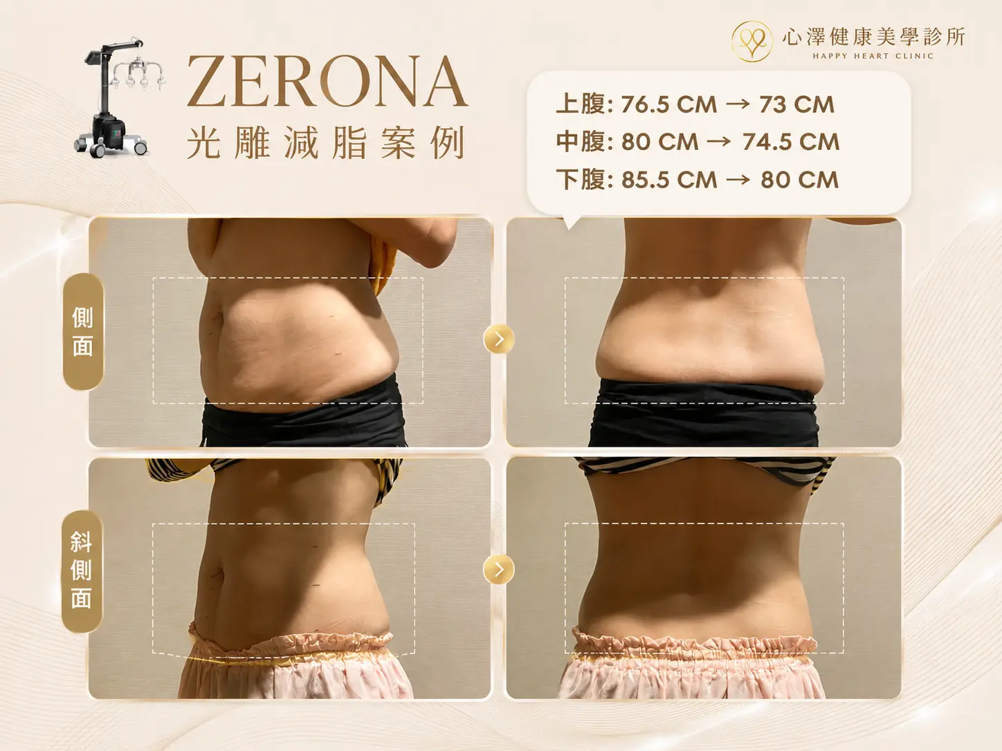 ZERONA光雕減脂案例
