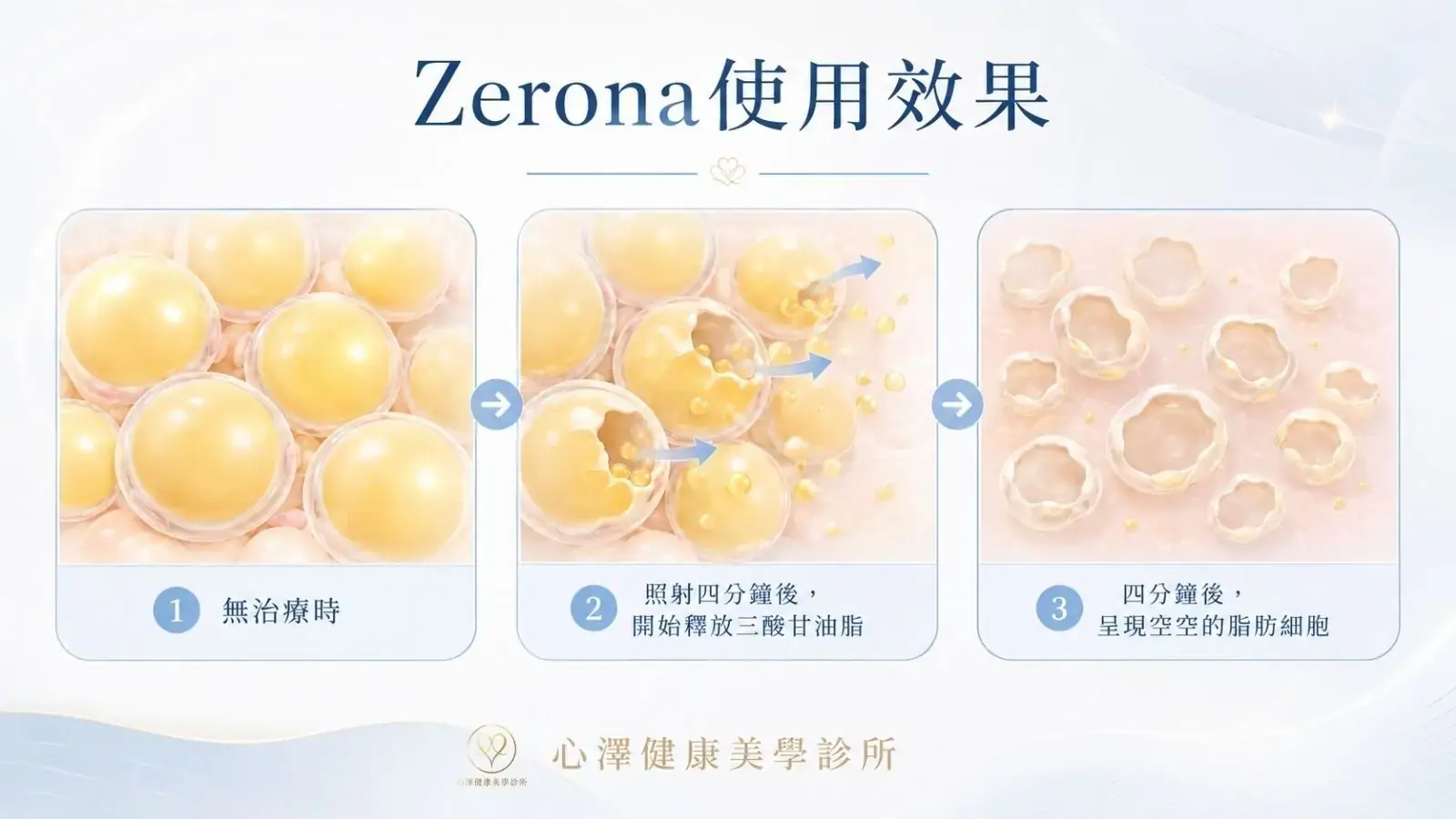 ZERONA光雕減脂原理