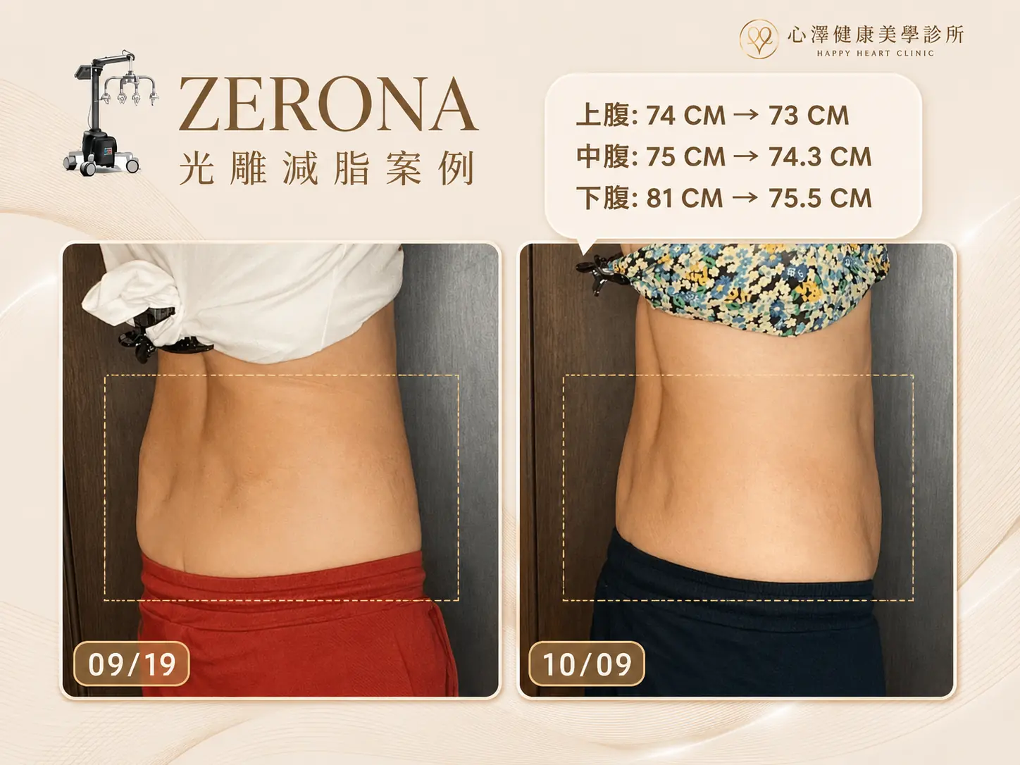 ZERONA光雕減脂案例