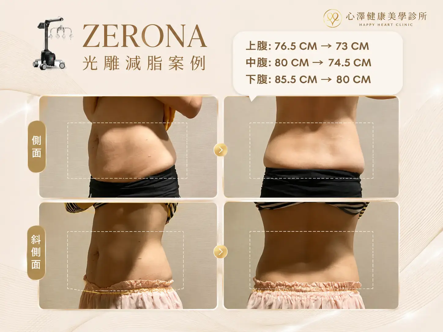 ZERONA光雕案例 