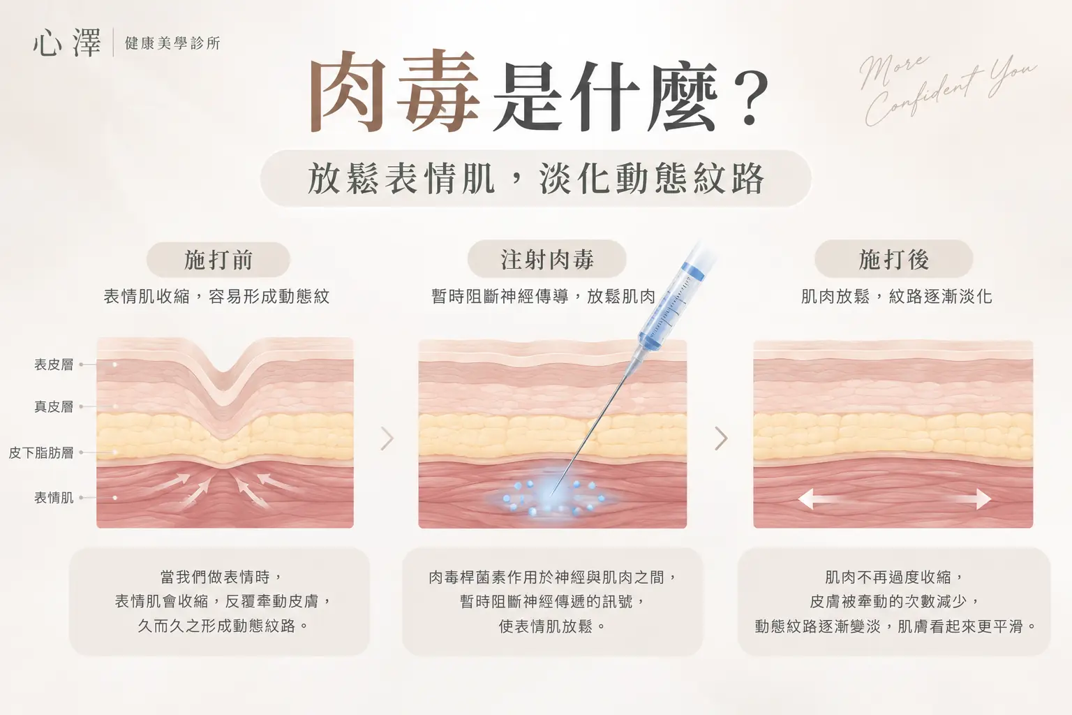 肉毒放鬆表情肌，淡化動態紋路