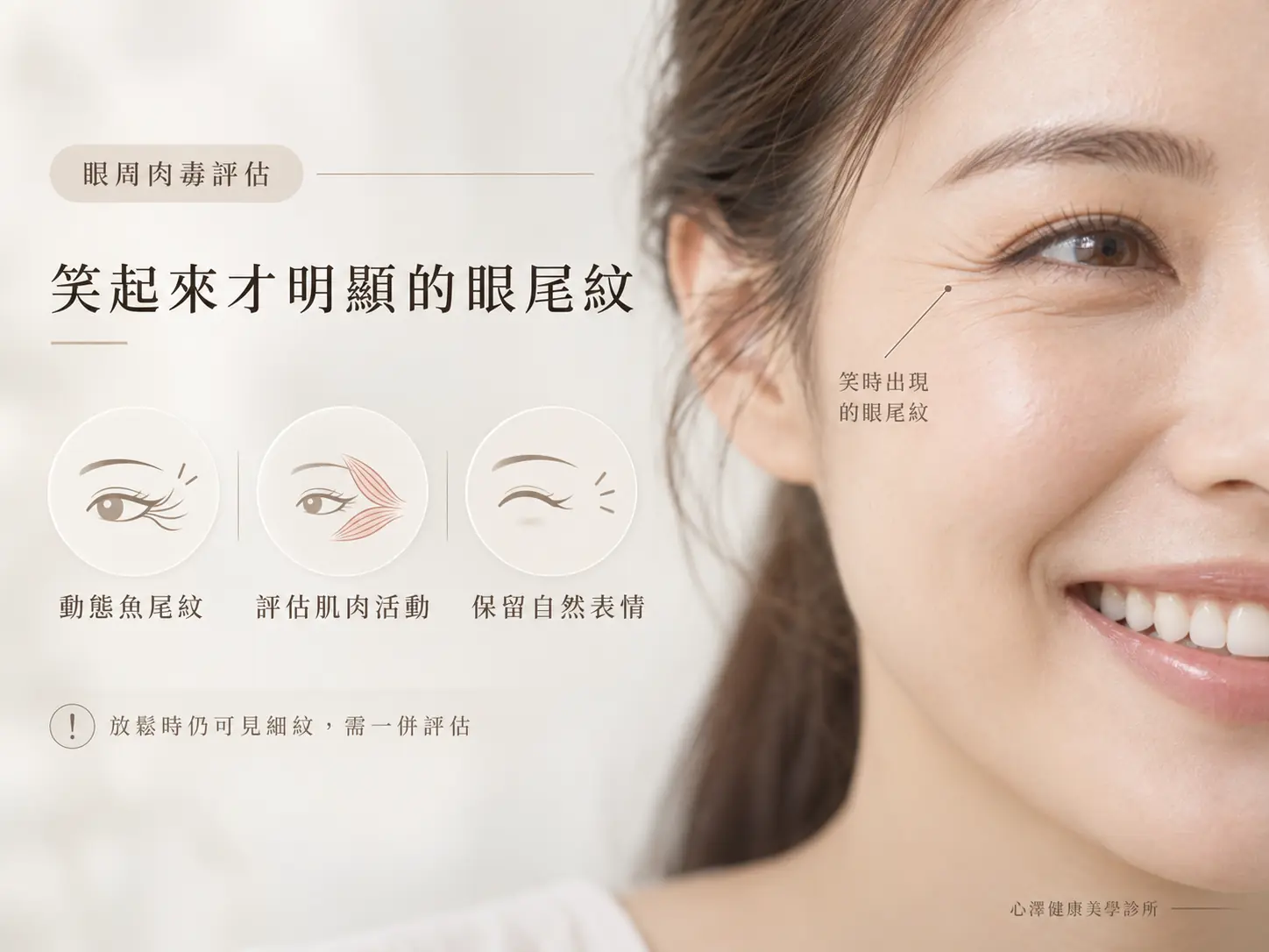笑起來才明顯的眼尾紋：眼周肉毒的評估重點